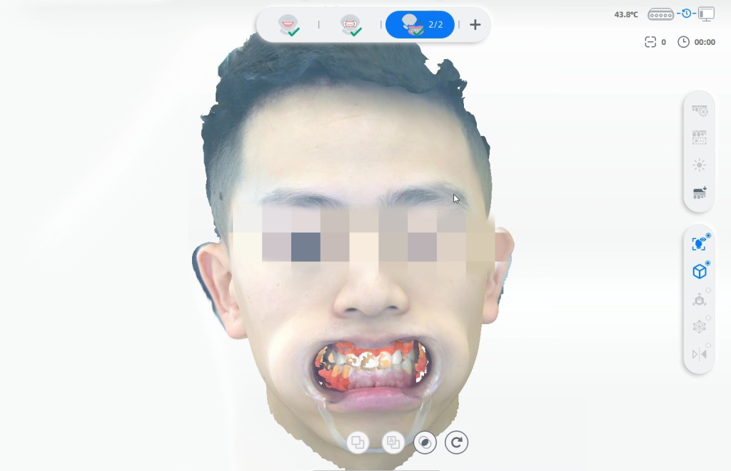 The auto alignment between extracted facial data and intraoral data